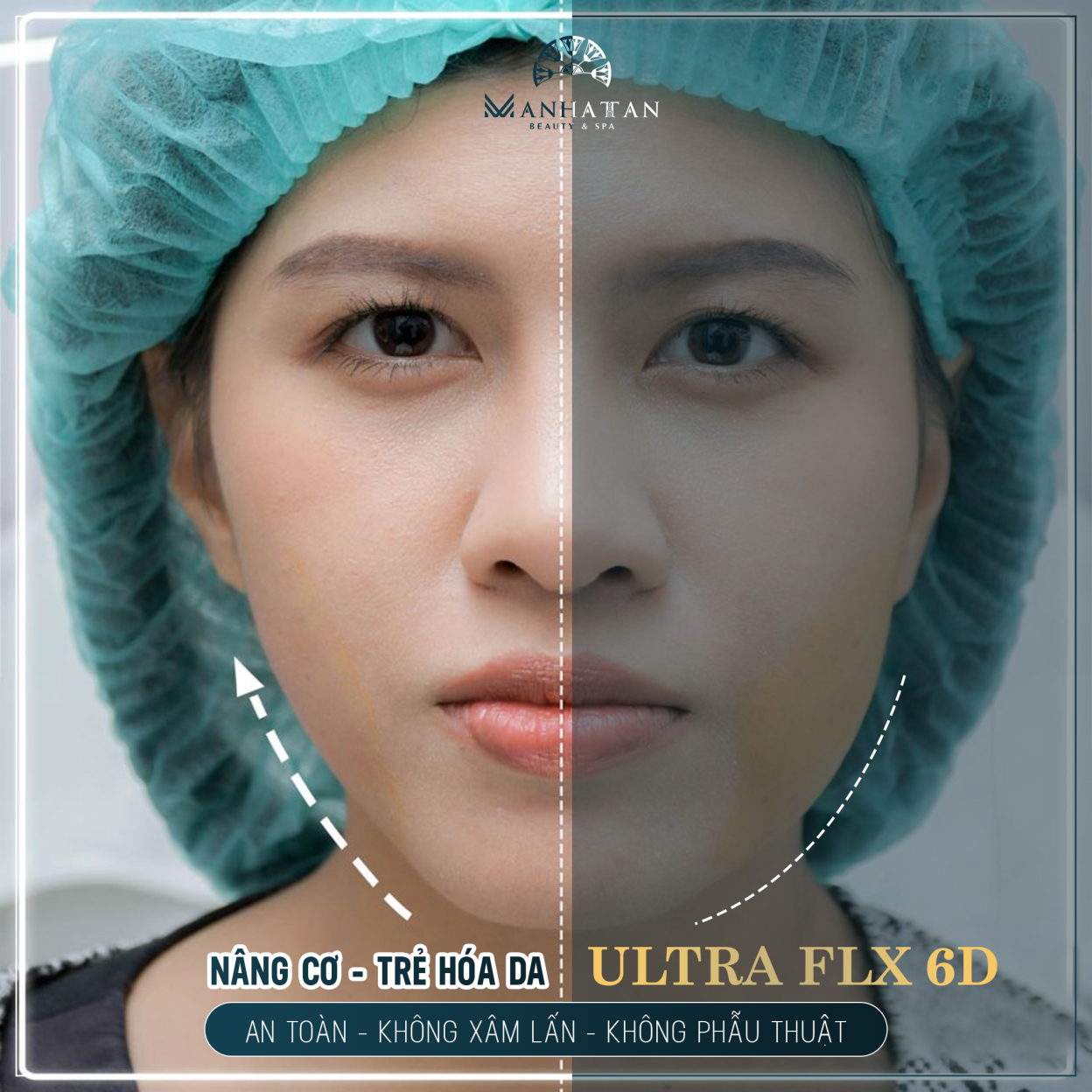 Khắc phục da lão hóa không cần phẫu thuật với công nghệ Ultra FLX 6D 2020, níu giữ thanh xuân